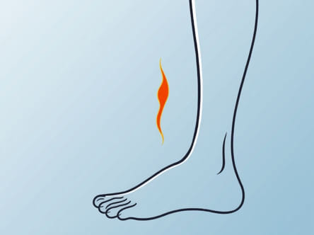 Cauterize Vein In Leg