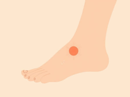 Signs Plantar Fasciitis Is Healing