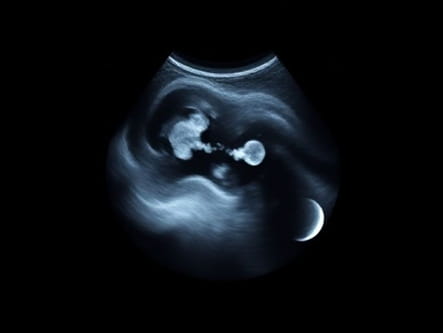 Ultrasound Images Of Capsular Contracture