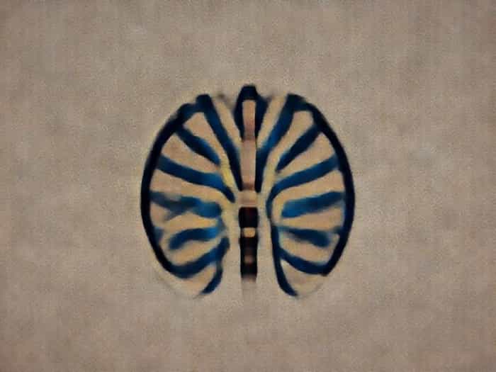 What Is Cortical Dysplasia