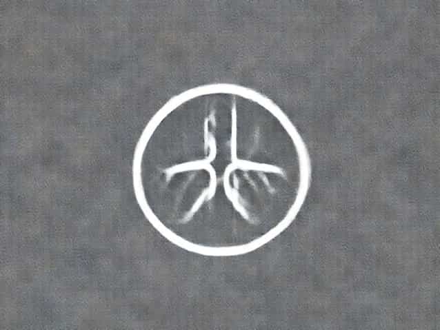 Can Bilateral Tubal Blockage Be Cured