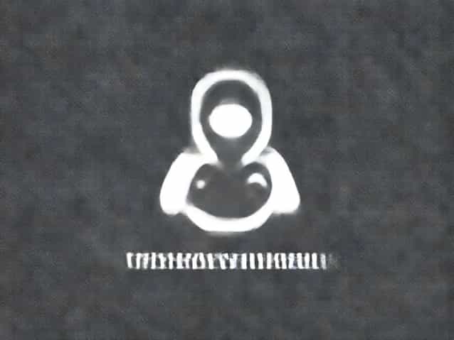 Rheumatic Fever Hypersensitivity Type